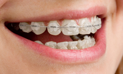 Dental Alignment in Eugene & Creswell, OR